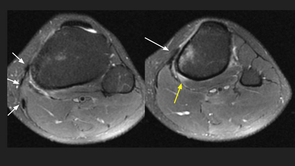 Figure 2 for case tibial stress reaction